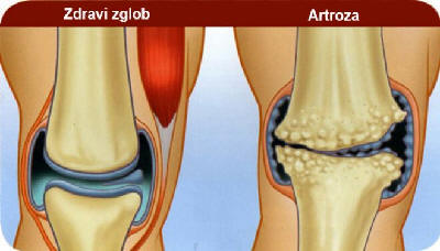 BOL U KUKU – osteoartritis kuka